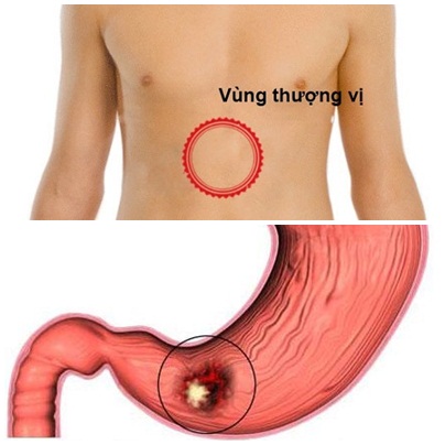 triệu chứng viêm loét dạ dày tá tràng